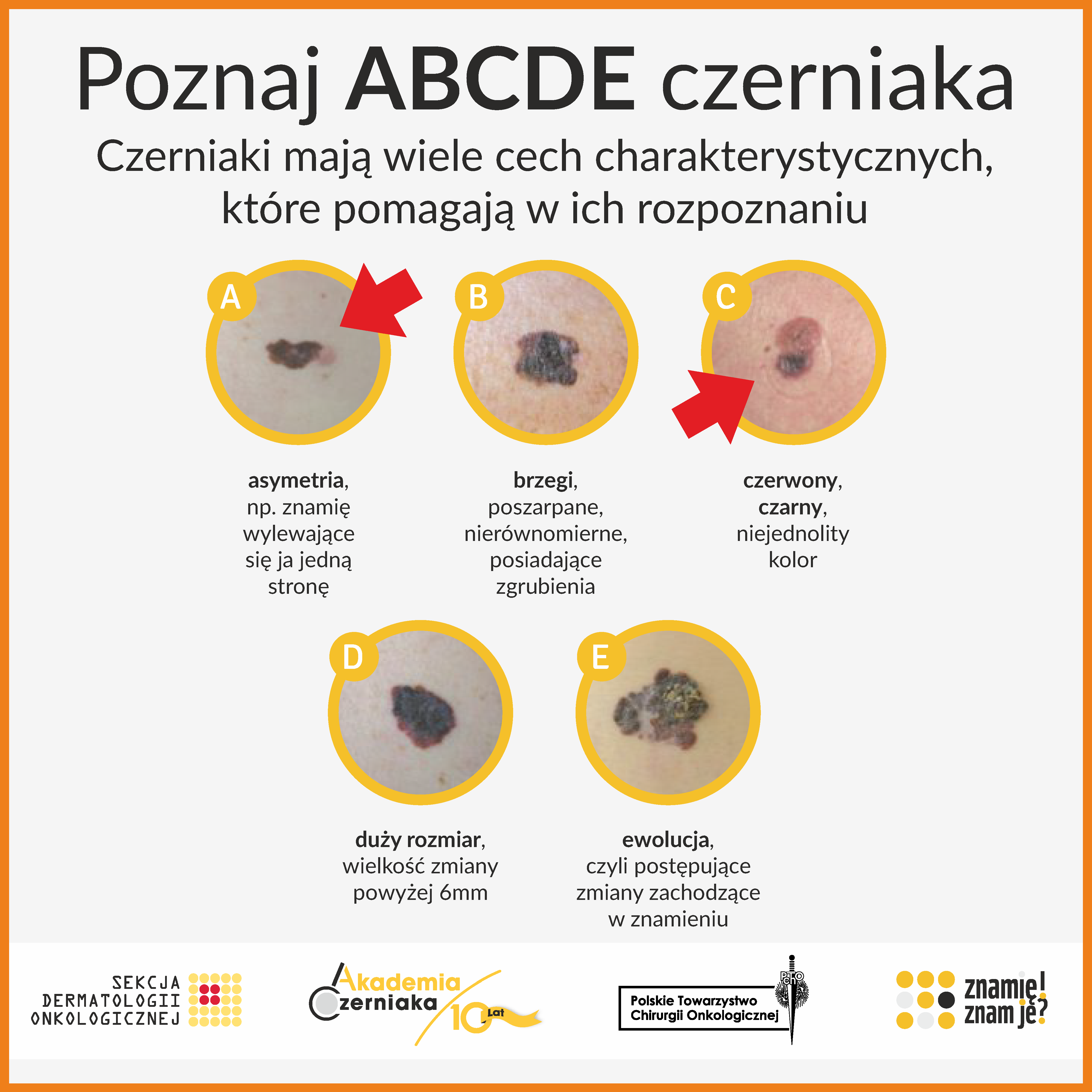 ABCDE czerniaka.png